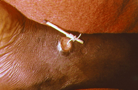 guineaworm2j_lores.jpg