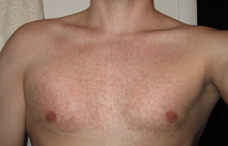 chest2weeks800.jpg