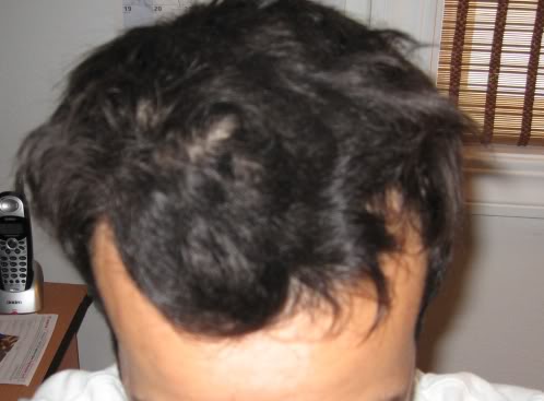 hairloss2.jpg