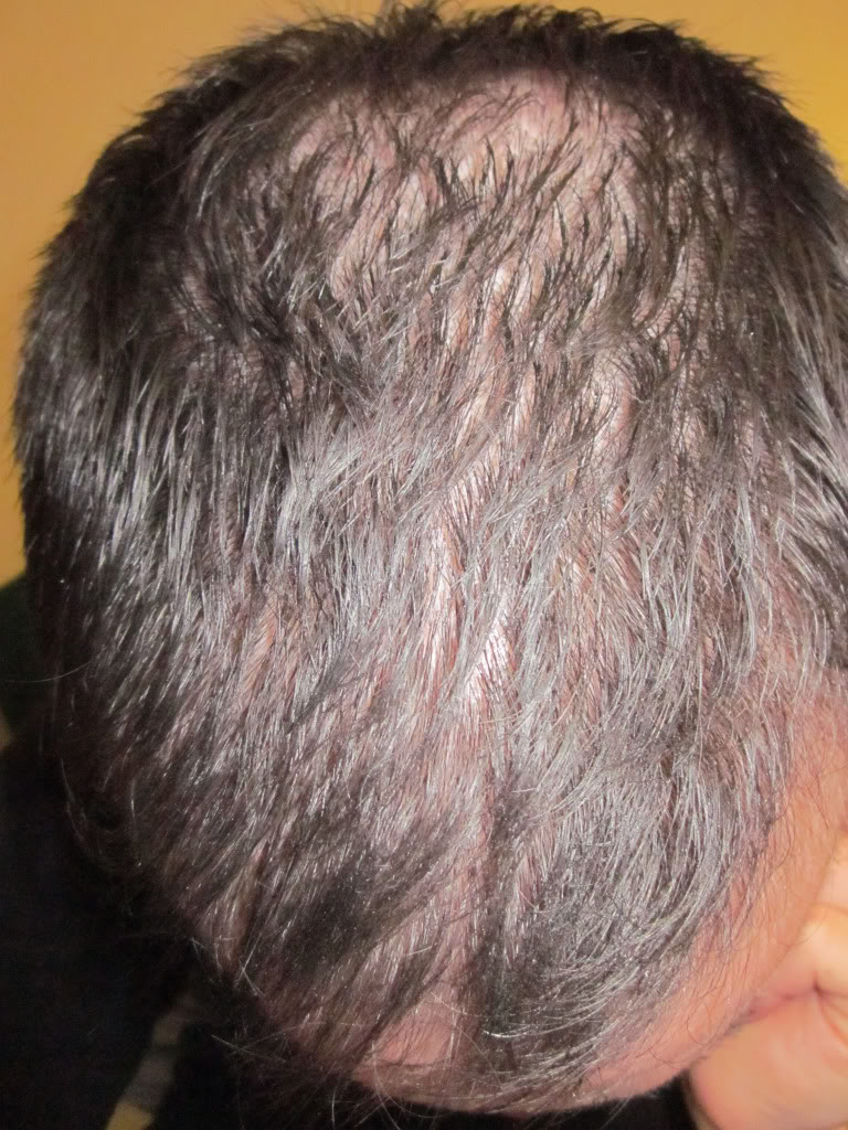 hairloss3.jpg