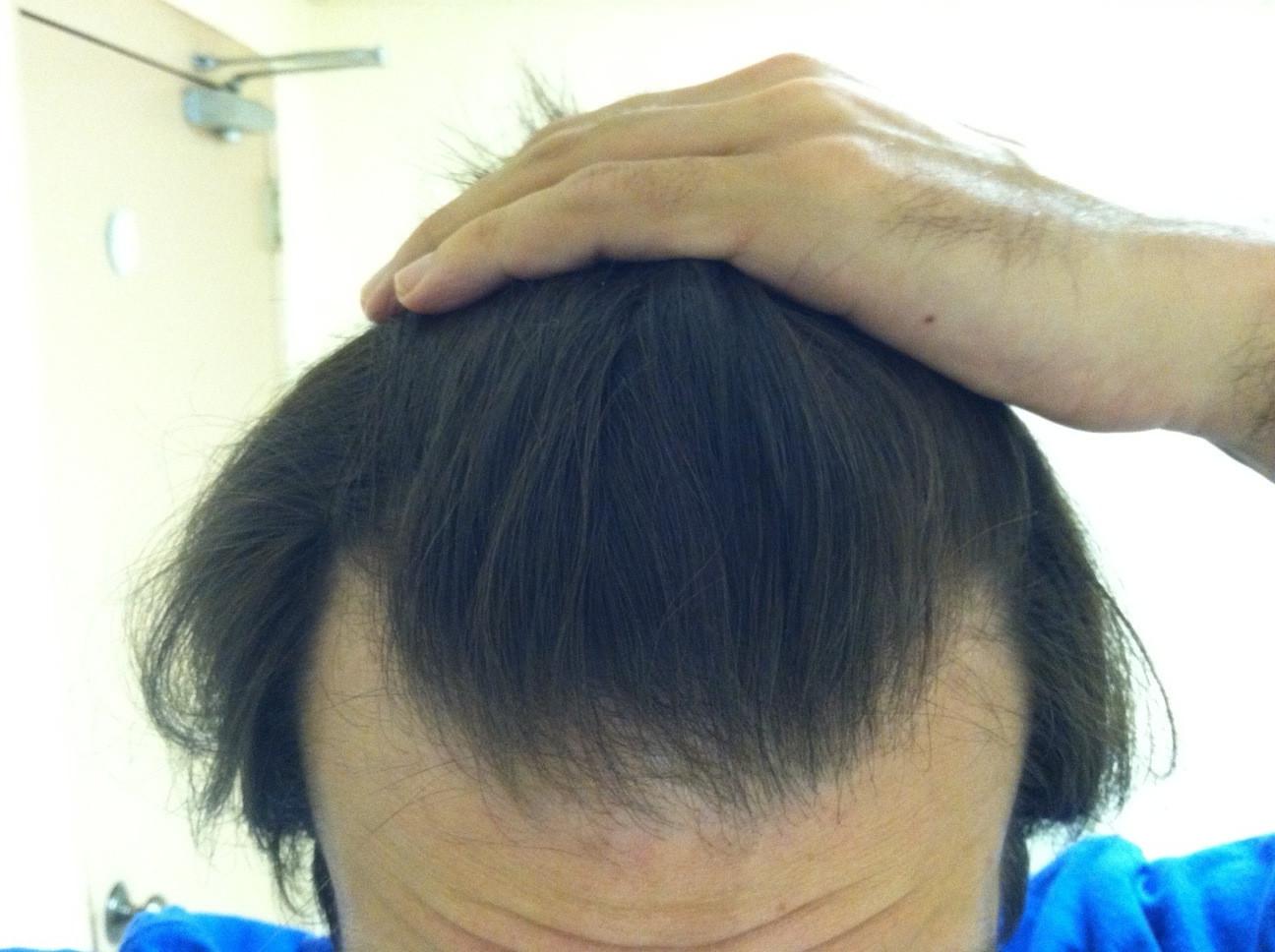 Receding, especially thin front middle of hairline | HairLossTalk Forums