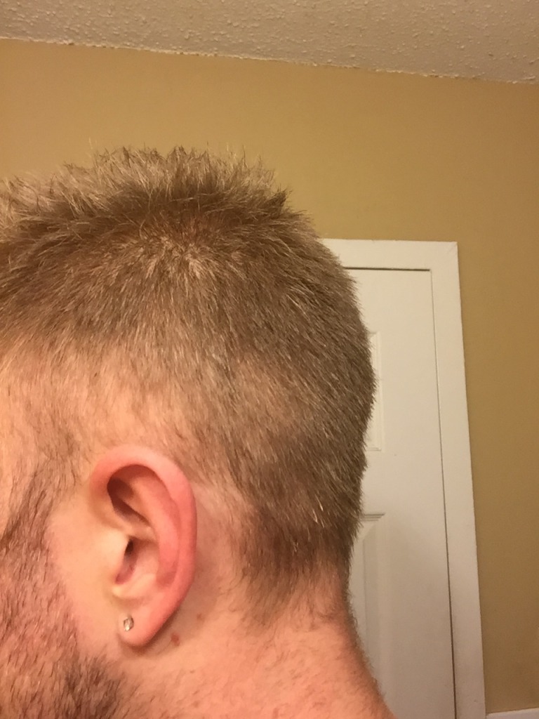 Losing hair on sides of head as well? | HairLossTalk Forums