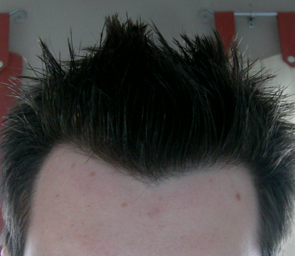 Am I receding and if so why more on one side than the other?? |  HairLossTalk Forums