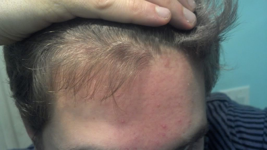 Thinning on front of hairline? | HairLossTalk Forums