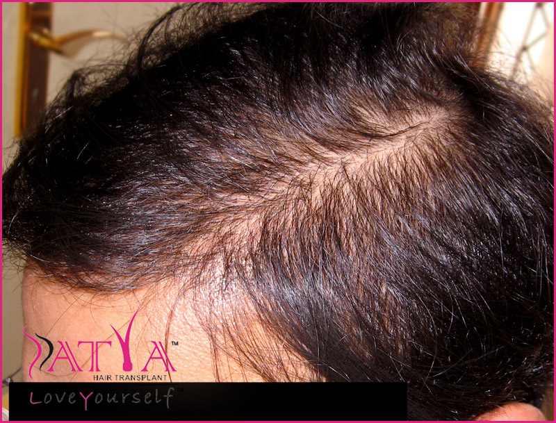 After-4000-biofibres-Synthetic-Hair-Transplant-Treatment.jpg