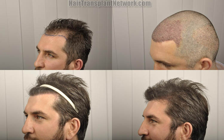 hair-transplantation-pictures-left-172773.jpg
