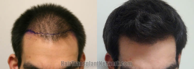 hair-transplant-surgery-front-163648.jpg