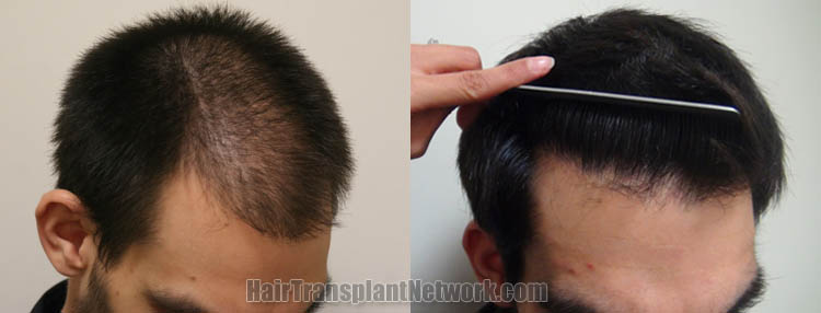 hair-transplant-surgery-pictures-right-163648.jpg