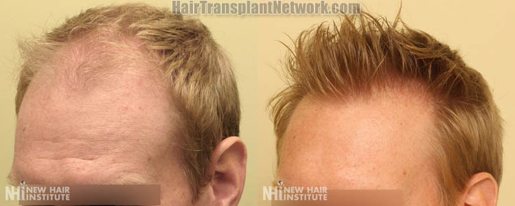 hair-restoration-image-left-158670.jpg