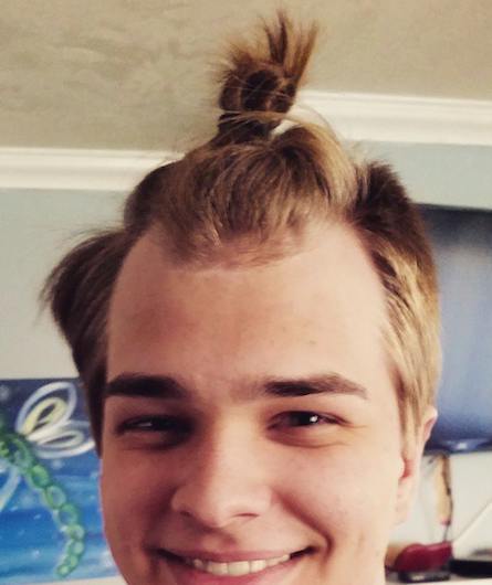 A-picture-of-a-young-balding-male-with-a-man-bun-hairstyle-and-a-Norwood-3-stage-of-hair-loss.jpg