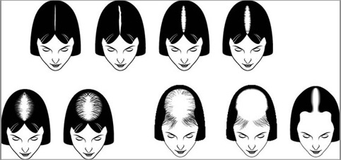 female-patern-baldness.jpg