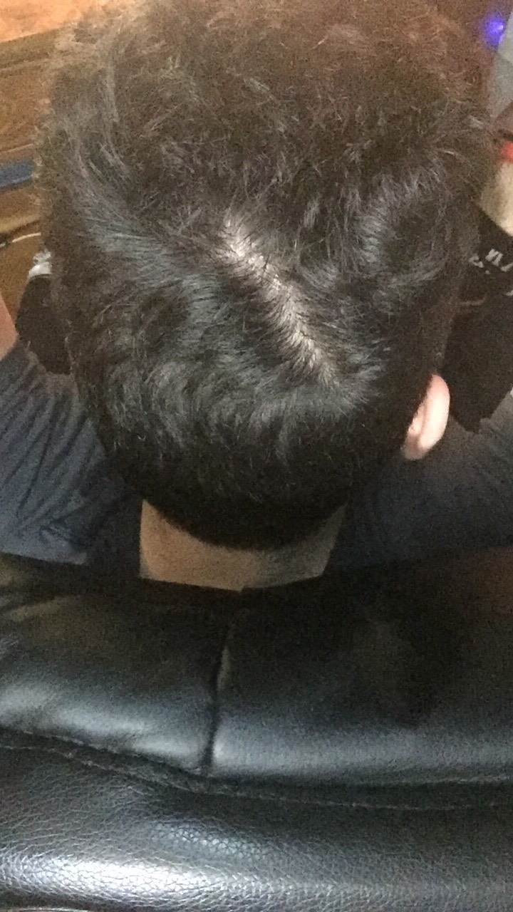 Am I Balding? Bald Spot On Crown And Worried! | HairLossTalk Forums