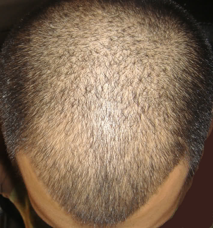 switching from finasteride to dutasteride results
