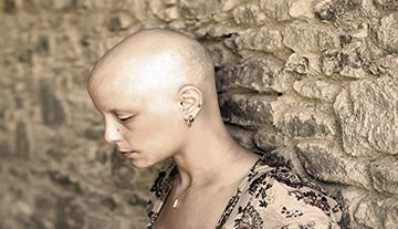 Alopecia Support
