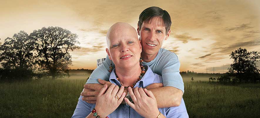 Alopecia Universalis Information