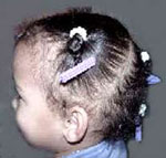 Children's Traction Alopecia