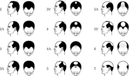 Norwood Scale