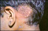 Tinea Capitis Treatments