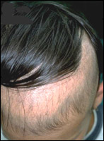 Diagnosing Trichotillomania