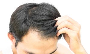 Finasteride Propecia