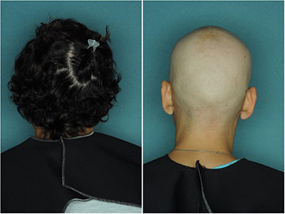 Alopecia Areata Stopping JAK3 Treatment