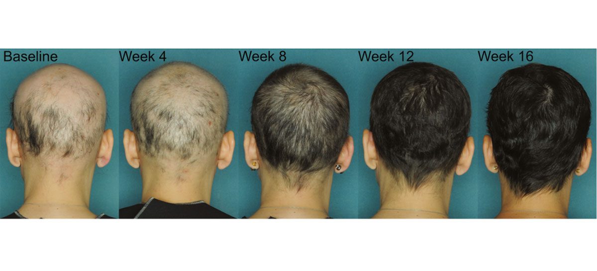 New Study Confirms JAK3 Effective in Alopecia Areata