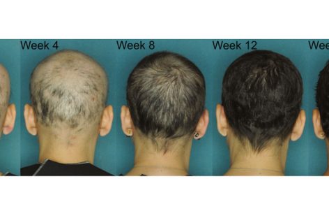 New Study Confirms JAK3 Effective in Alopecia Areata