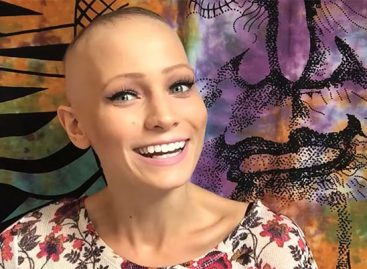 22 Year Old Alopecia Areata Spokeswoman: Abby Andrew