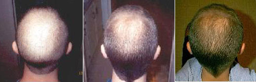 Before After Hair Loss