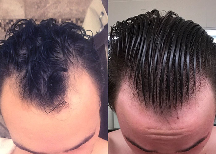 how to get avodart for hair loss