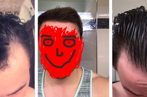 Is it Really Possible to Regrow Your Hair?  This Guy Did.